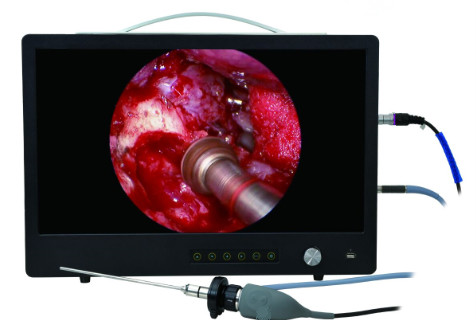 Portable Full HD endoscopy camera system